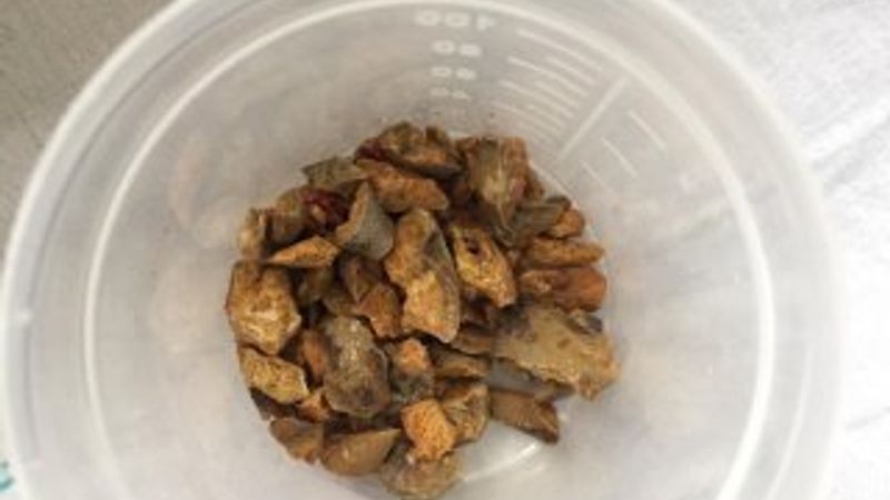 Bir hastadan, 152 parça taş çıkartıldı