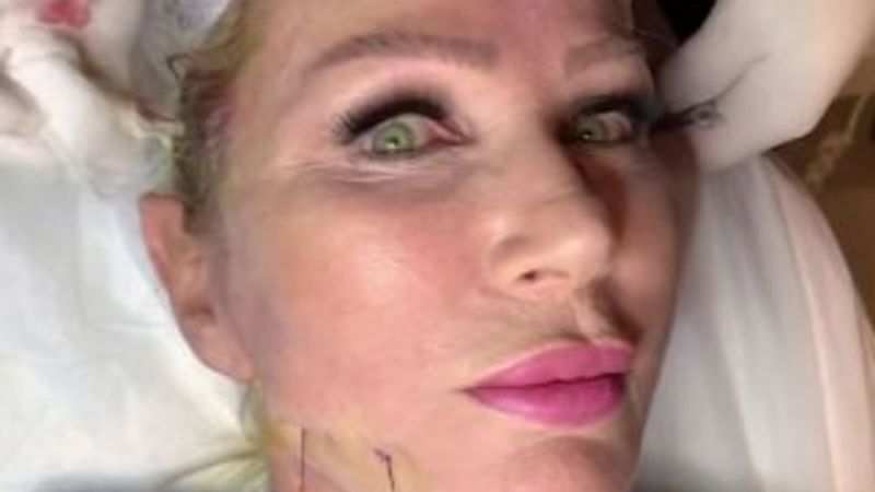 Seda Sayan canlı yayında estetik yaptırdı