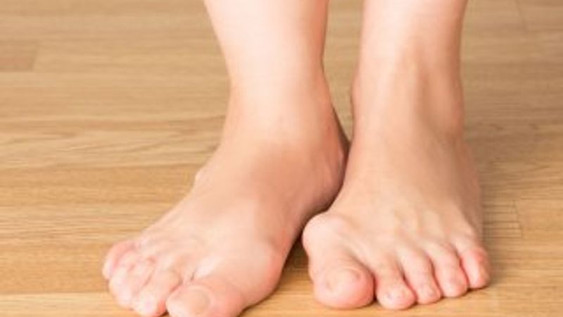 Halluks Valgus nedir