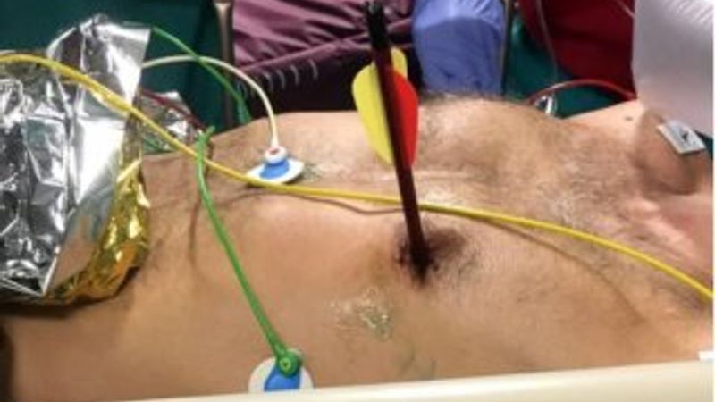 Göğsüne ok saplanan adam hayata tutundu