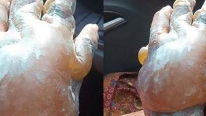 Diş macunu yanıklara iyi gelmiyor