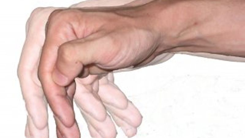 Parkinson hastalığı nedir