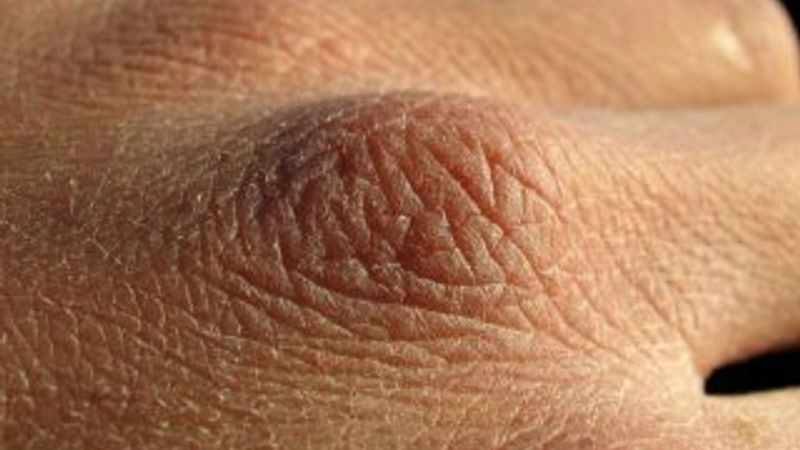 Balık pulu hastalığı nedir