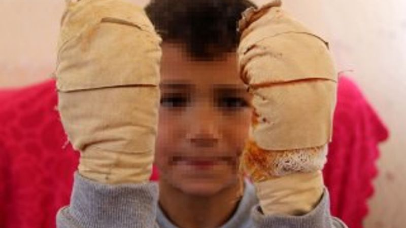 Erzurum'da komşu çocuğu, arkadaşının ellerini yaktı