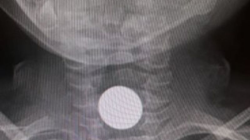 Bursa'da 1 lirayı yutan çocuk, hastanelik oldu