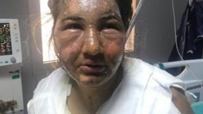 İstanbul'da cezaevinden çıkıp eski karısının yüzünü yaktı