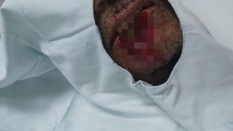 Kayınpederinin dudağını ısıran damat tutuklandı