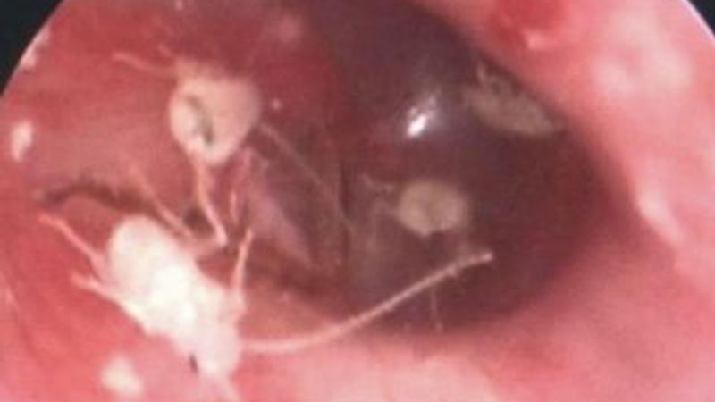 Kulağından 11 hamam böceği çıktı