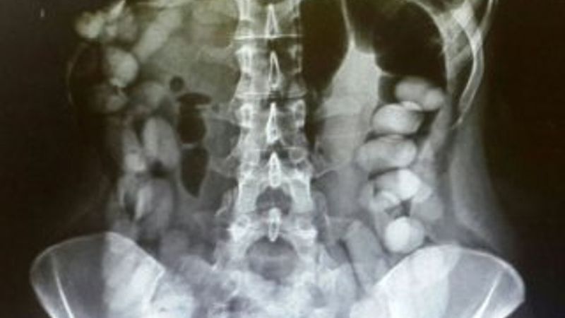 Midesinden 1,2 kilo uyuşturucu çıktı