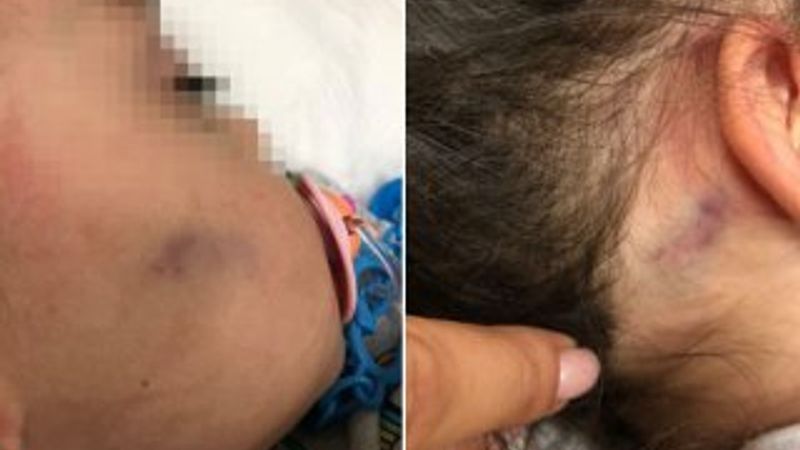 Küçük çocuğun işkence gördüğü anaokulu kapatıldı