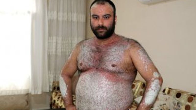 Sedef hastalığına yakalandı, yardım bekliyor