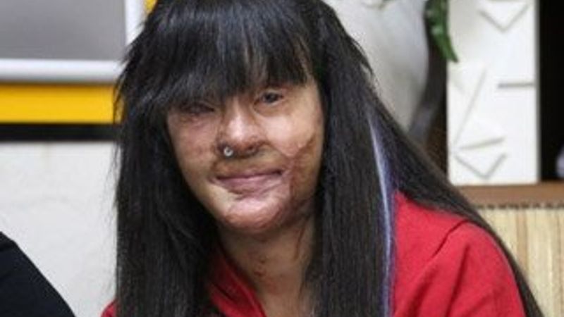 Yüzü asitle yakılan Berfin: Çektiğim acı, 1-2 yıla sığmaz