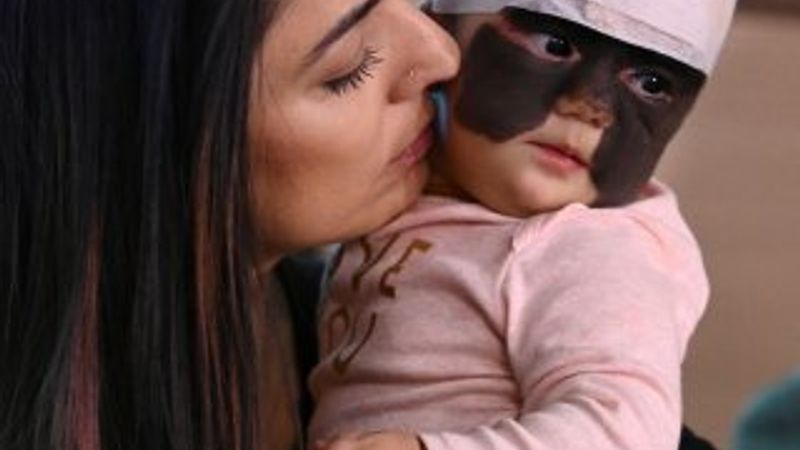 Nadir görülen cilt hastalığı ile doğdu