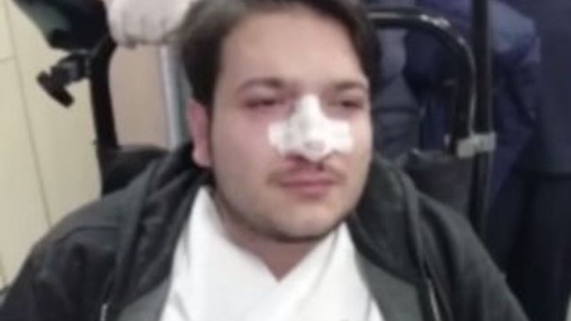 Randevusuz hasta doktorun burnunu kırdı