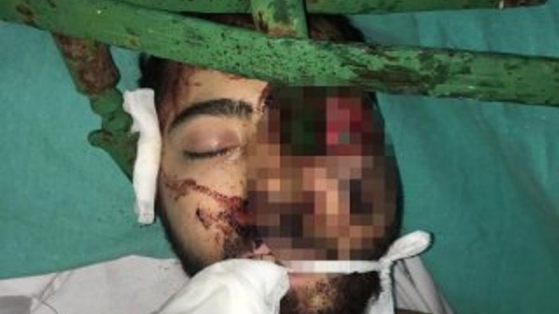 Trafik kazasında yüzüne demir saplandı