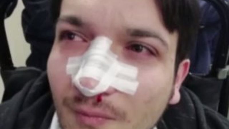 Doktorun burnunu kıran şüpheli teslim oldu