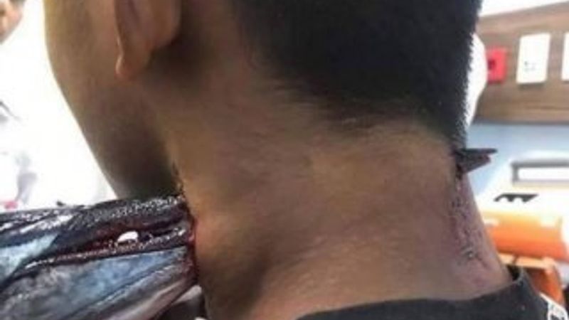 İğne balığı saldırısında bir çocuk yaralandı