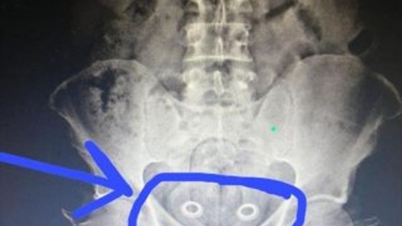 İranlı bir kişinin mide ve bağırsağından uyuşturucu çıktı