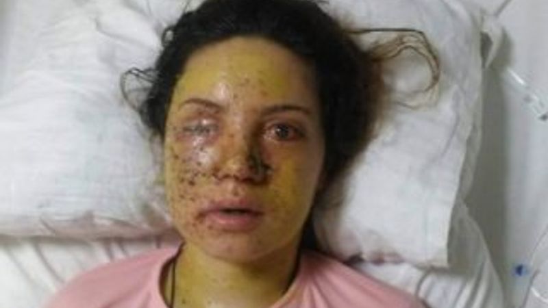 Eşi tarafından vurulan genç kadın gözünü kaybetti