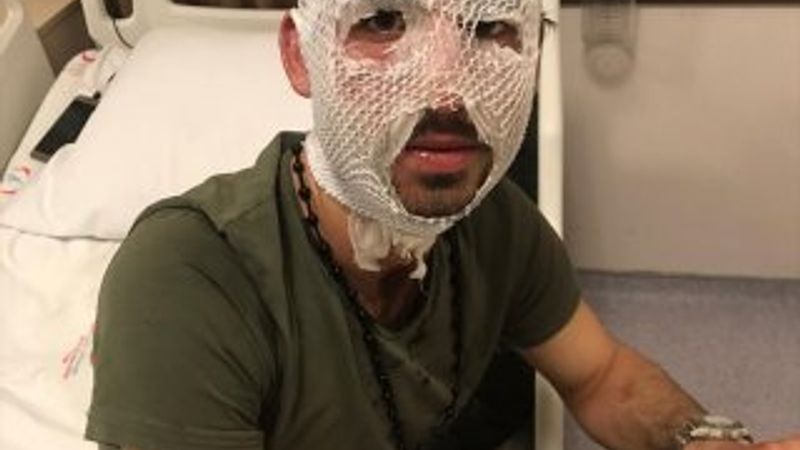 Yunan sınır polisi, sığınmacının üzerine kaynar su döktü