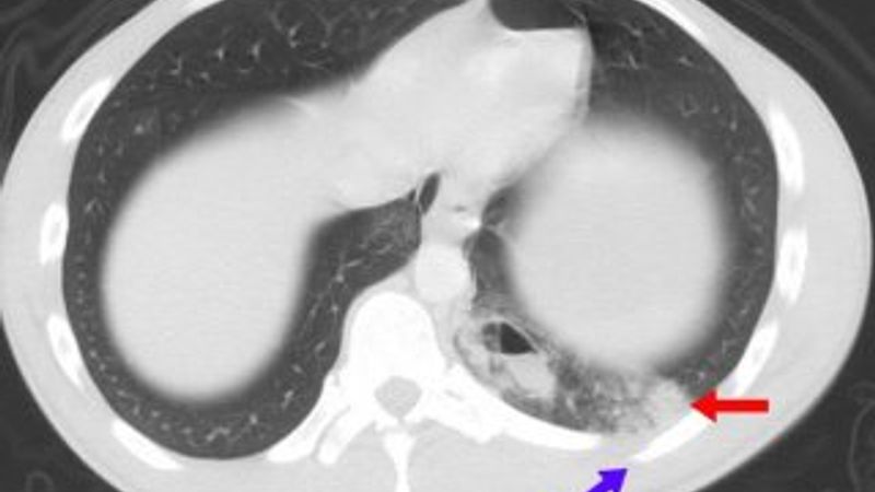Asemptomatik hastalık nedir