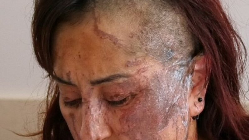 Isparta’da boşanmak isteyen kadına kezzaplı saldırı