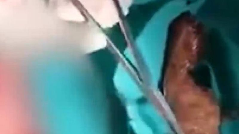 Çinli adamın rektumundan balık çıktı