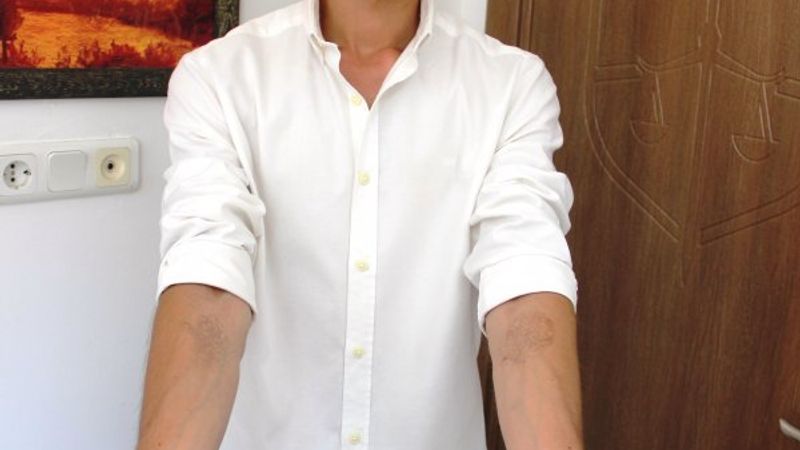 Muğla'da dövmelerini sildirmek isterken cildi çürüdü