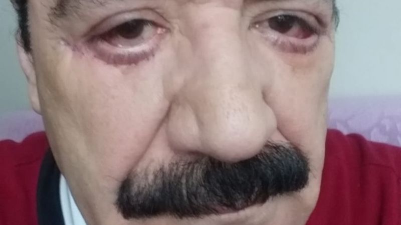 İstanbul’da ‘göz doktoru hatalı estetik yaptı’ iddiası