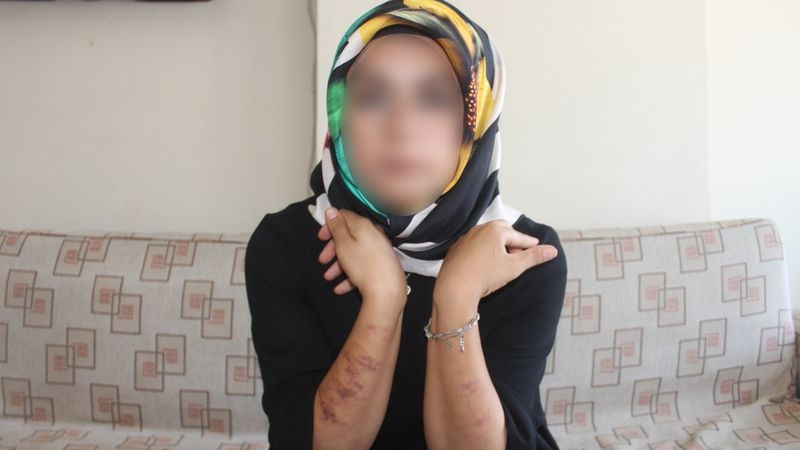 Adıyaman'da lazer yaptıran genç kadının vücudu yandı