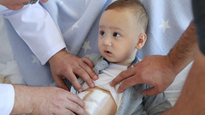 Samsun'da 1 yaşındaki bebeğin safra kesesinden 5 taş çıkarıldı