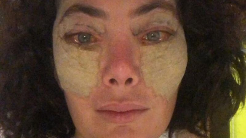 Akasya Asıltürkmen, estetik yaptırdı