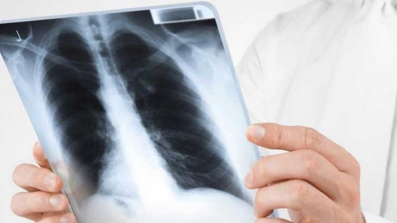 Sinsi hastalık veremin erken teşhisi hayat kurtarıyor