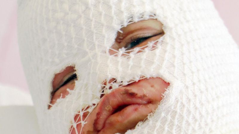 Kars'ta 2 yaşındaki çocuğun üzerine çaydanlık devrildi