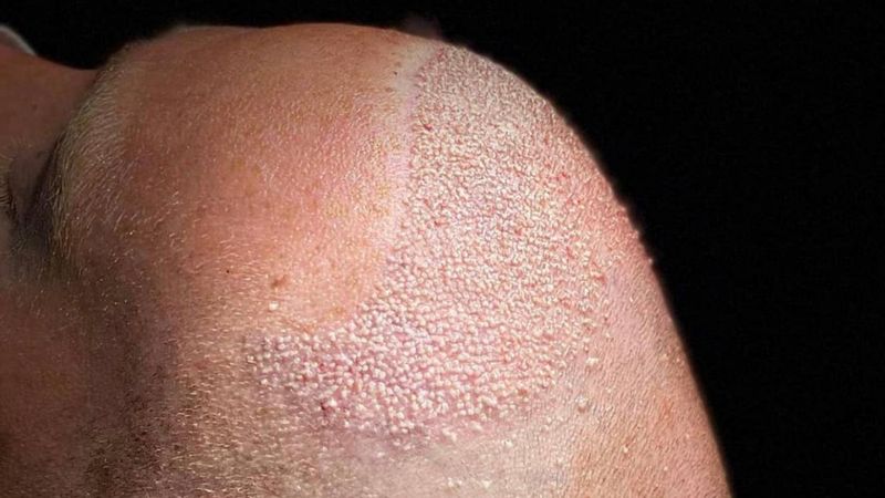 Saç ekimi sonrası ay ay değişim