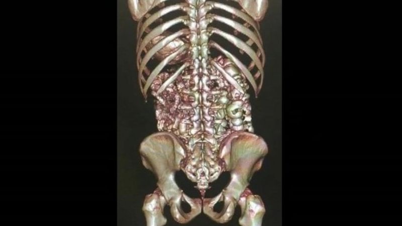 İstanbul Havalimanı'nda, midesinde uyuşturucu taşıyan kuryeler yakalandı