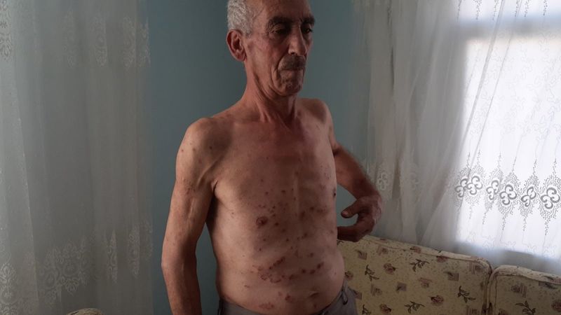 Osmaniye’de 13 yıldır kaşıntısına çare arıyor