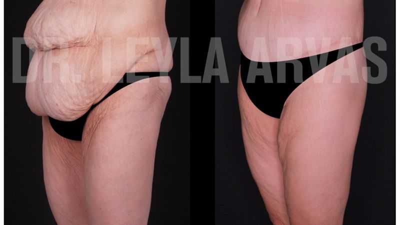 Doğum Sonrası Karın Germe Ameliyatı Ve Meme Estetiği