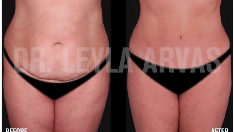 Meme estetiği ile karın germe mükemmele çok yakın