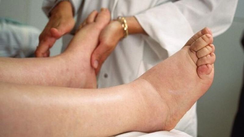 6 Mart Dünya Lenfödem Farkındalık Günü! Lenfödem (fil hastalığı) belirtileri nelerdir, tedavisi var mı?