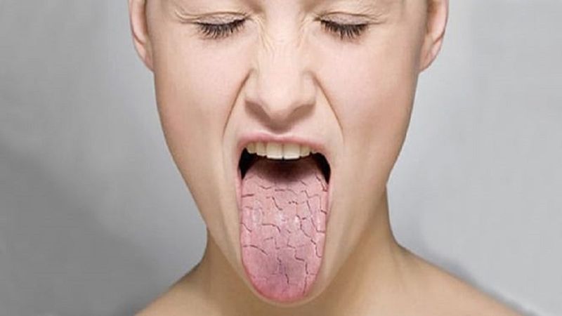 Sjögren sendromu nedir, belirtileri nelerdir? Sjögren sendromu tedavisi var mı?