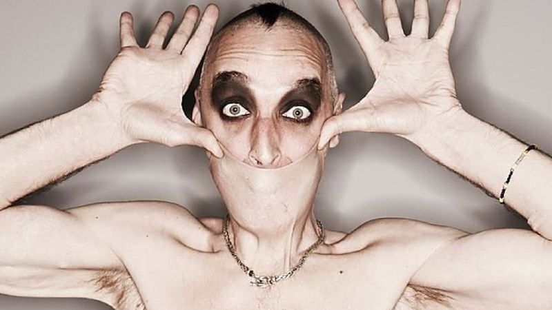 Ehlers Danlos Sendromu nedir, belirtileri nelerdir? Ehlers Danlos (EDS) Sendromu tedavisi var mı?