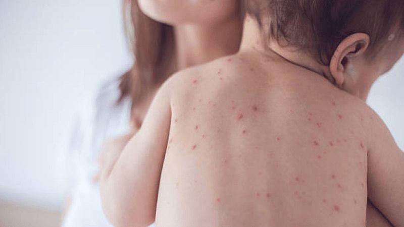 Kızıl hastalığı nedir, belirtileri nelerdir? Kızıl hastalığı tedavisi var mı?