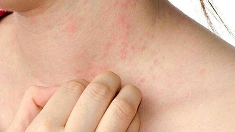 Uyuz hastalığı nedir, belirtileri nelerdir? Uyuz hastalığı nasıl geçer, tedavisi var mı?