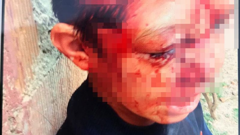 Kastamonu’da 8 yaşındaki çocuğa köpek saldırdı