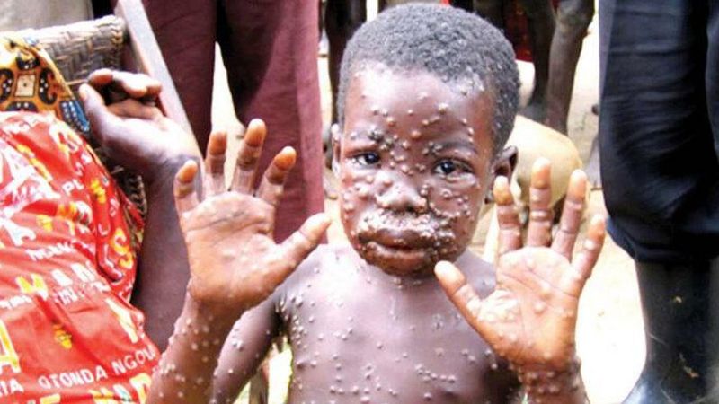 Avrupa'da yeni salgın: Maymun çiçeği virüsü nedir, belirtileri nelerdir?