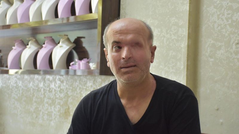 İzmir'de bir kuyumcu, uğradığı kezzaplı saldırı sonucu sol gözünü kaybetti