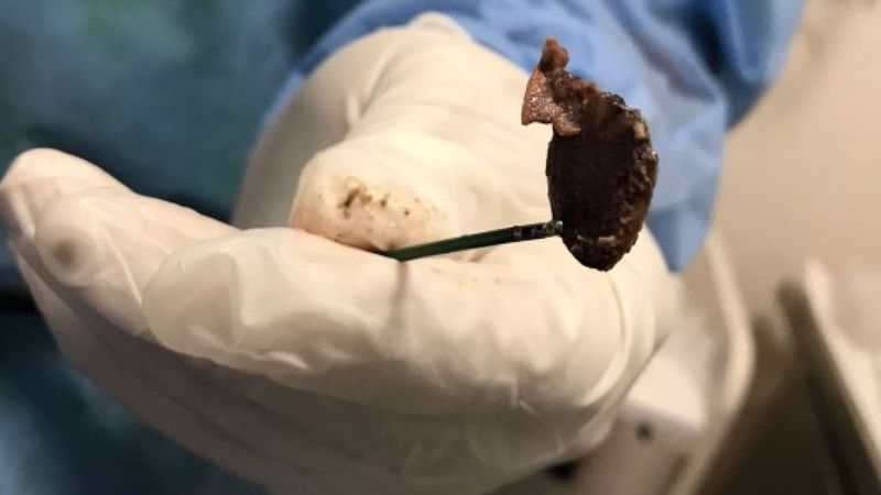 Karabük'te öksürük nedeniyle doktora giden kadının akciğerinden çekirdek çıktı