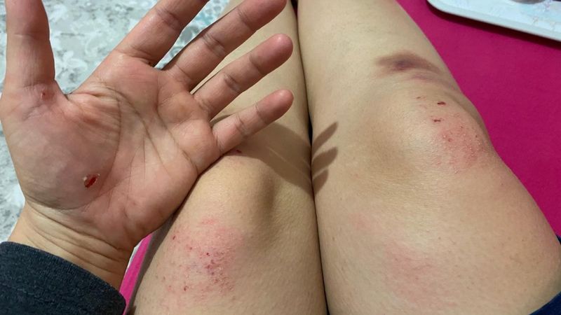 Malatya’da işe giderken köpeklerin saldırdığı kadın yaralandı