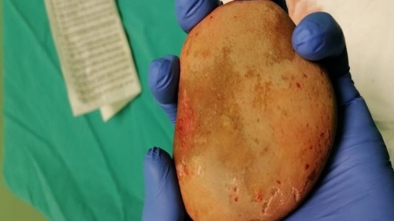 Ordu'da bir hastanın mesanesinden patates büyüklüğünde taş çıkarıldı